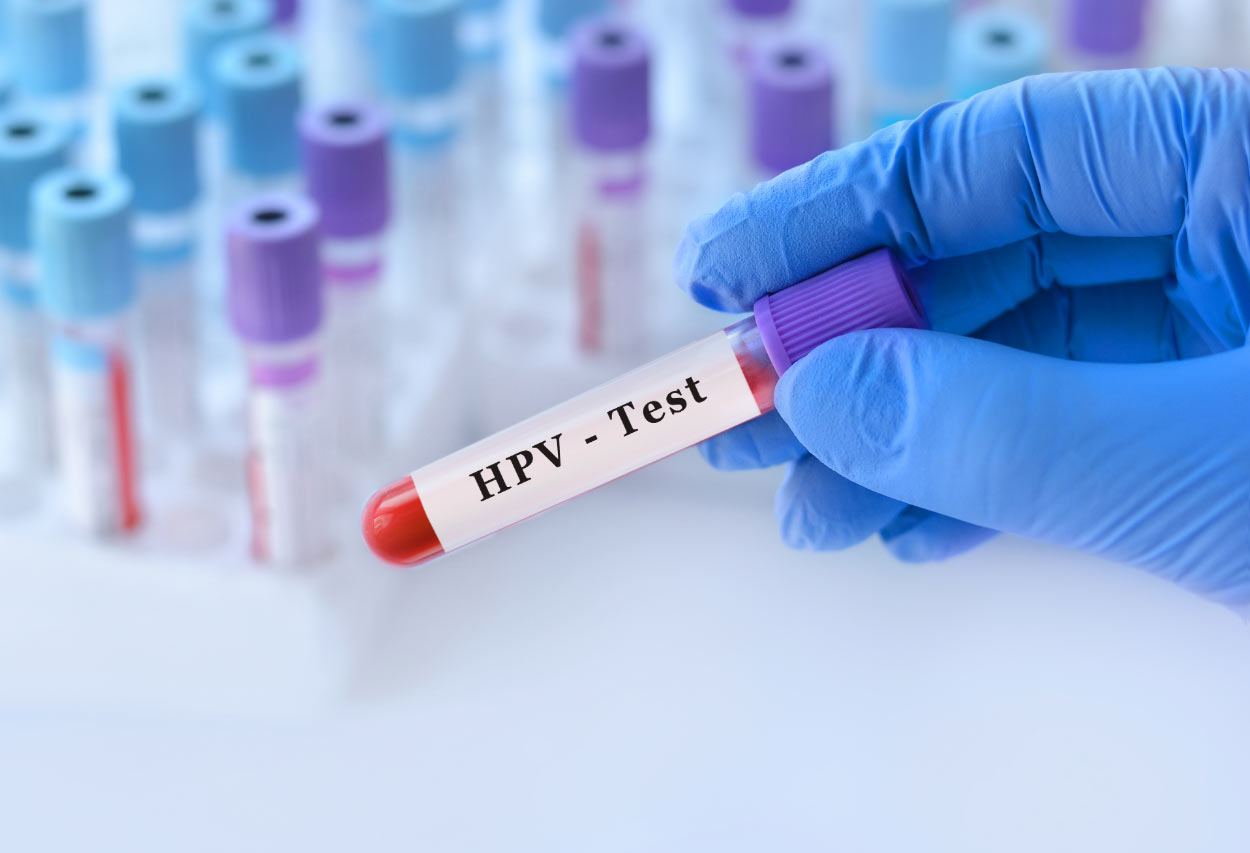 Dépistage du cancer du col de l’utérus